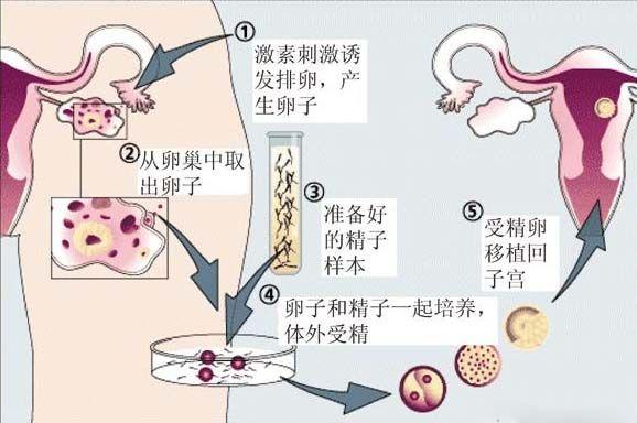 借卵试管代怀好吗_借卵试管代怀:一种可行的选择吗?